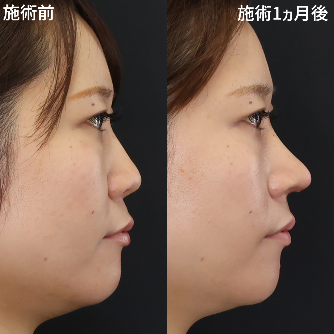 思い描いた理想を叶える《立体的な美鼻へ》