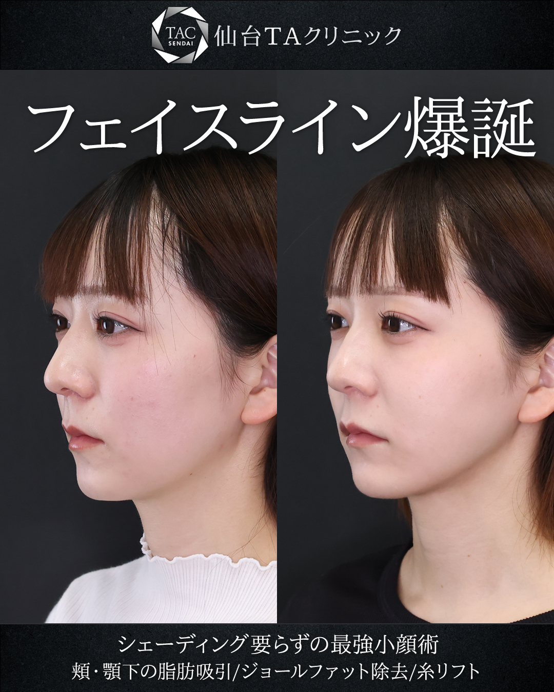 顔の脂肪吸引/TAC式 ツヤ肌コラーゲンリフト®/ジョールファット除去の症例写真 施術前後 