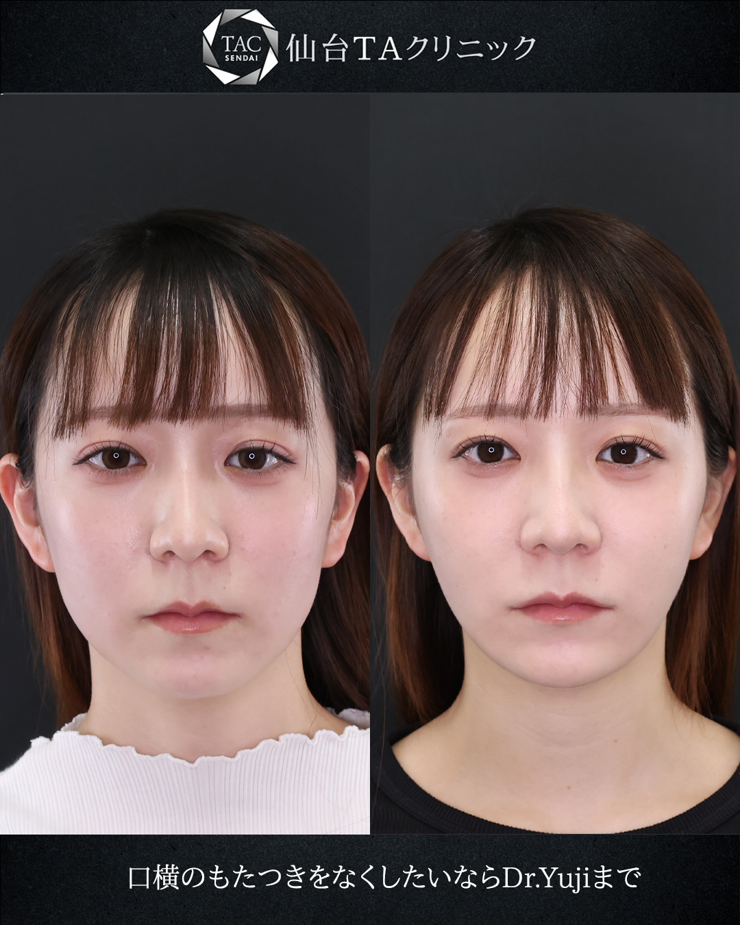 顔の脂肪吸引/TAC式 ツヤ肌コラーゲンリフト®/ジョールファット除去の症例写真 施術前後 