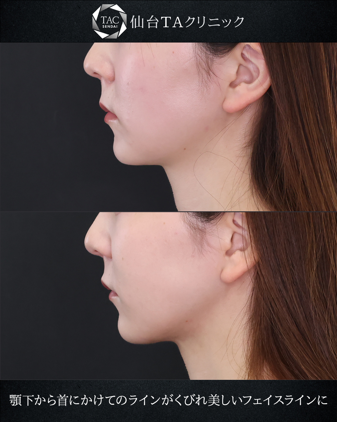 顔の脂肪吸引/TAC式 ツヤ肌コラーゲンリフト®/ジョールファット除去の症例写真 施術前後 