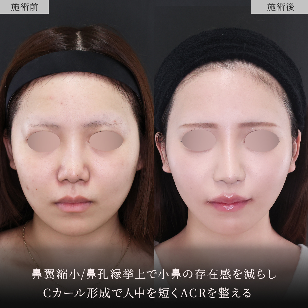 鼻中隔延長術/鼻尖形成・鼻尖縮小/鼻先軟骨移植の症例写真 施術前後 