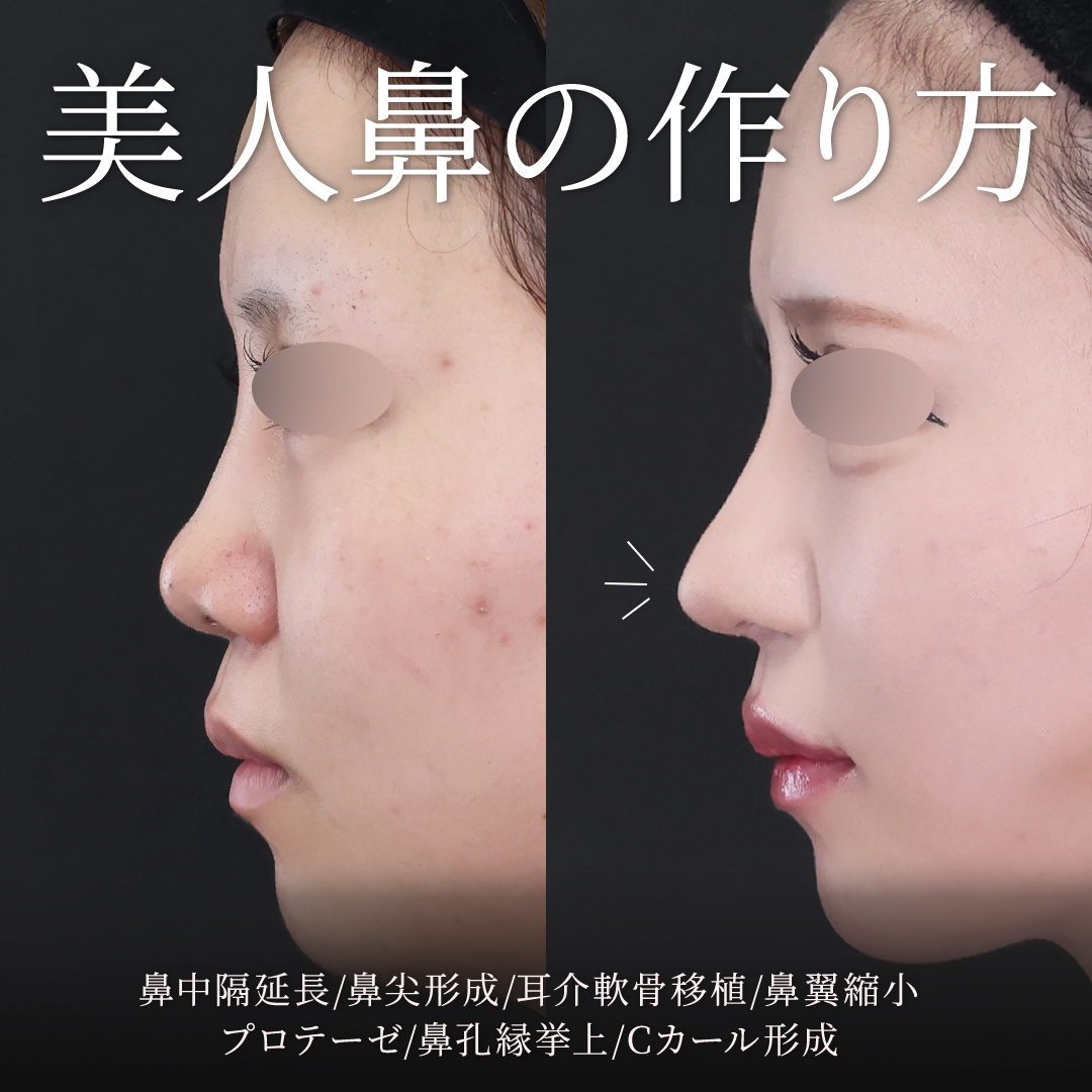 鼻中隔延長術/鼻尖形成・鼻尖縮小/鼻先軟骨移植の症例写真 施術前後 