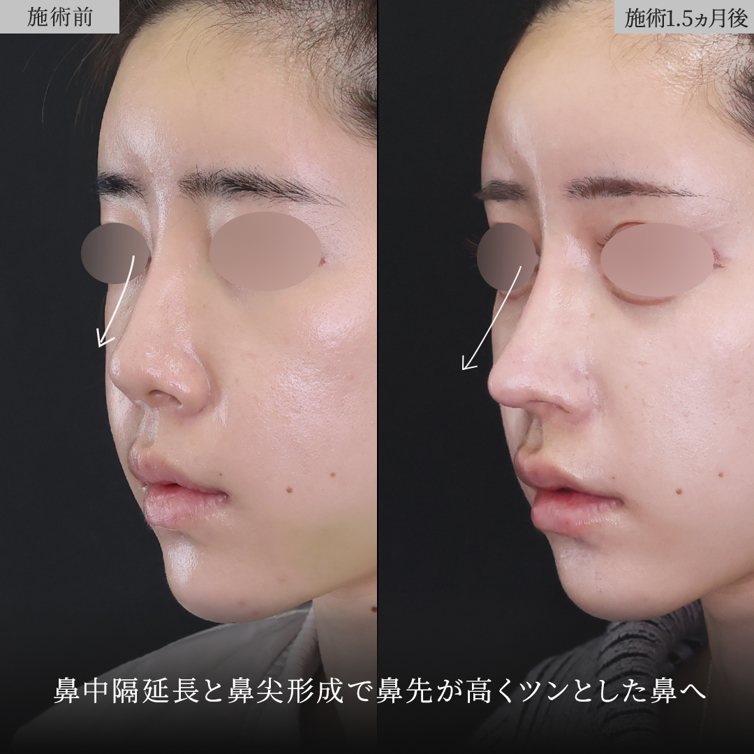 鼻中隔延長術/鼻尖形成・鼻尖縮小/鼻先軟骨移植の症例写真 施術前後 