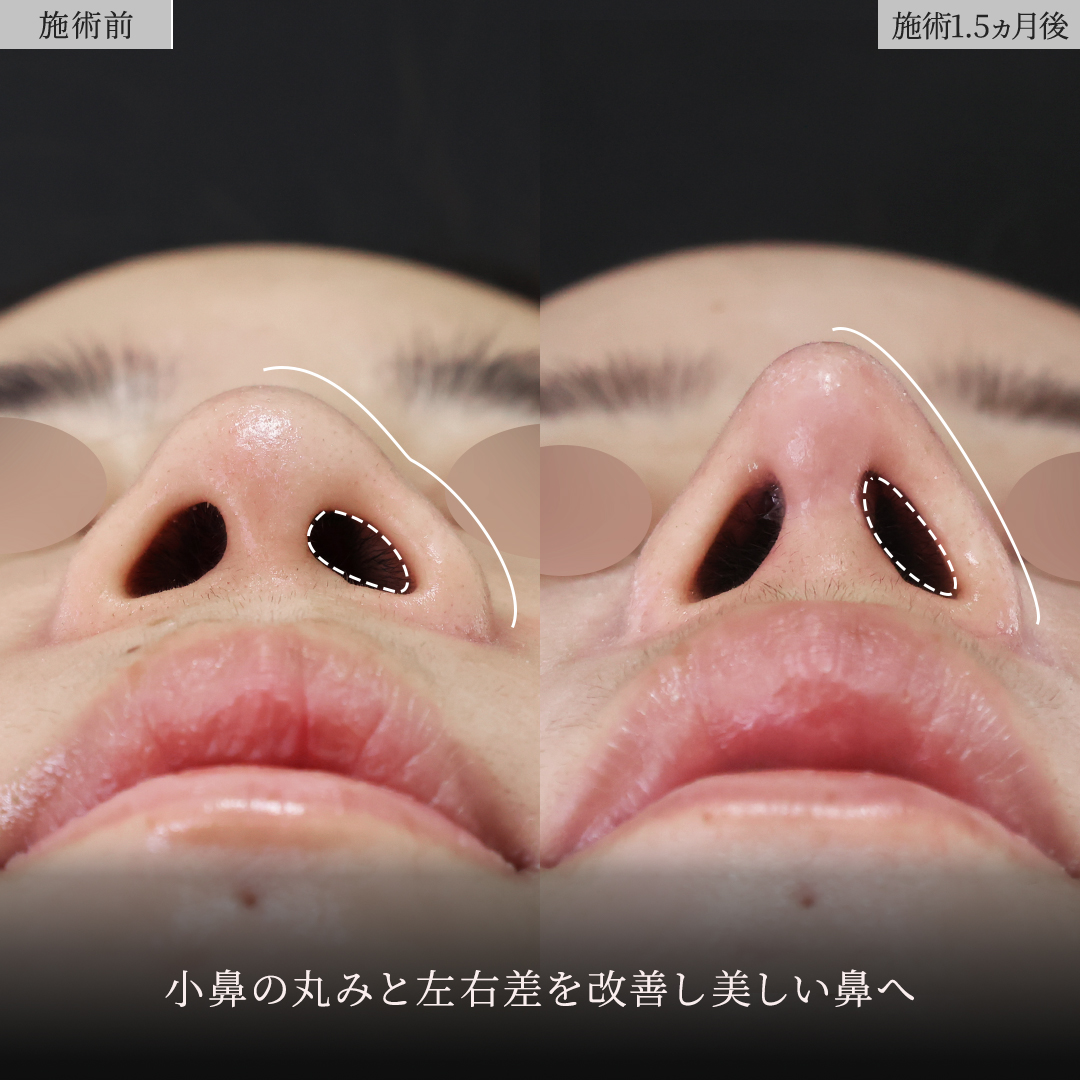 鼻中隔延長術/鼻尖形成・鼻尖縮小/鼻先軟骨移植の症例写真 施術前後 