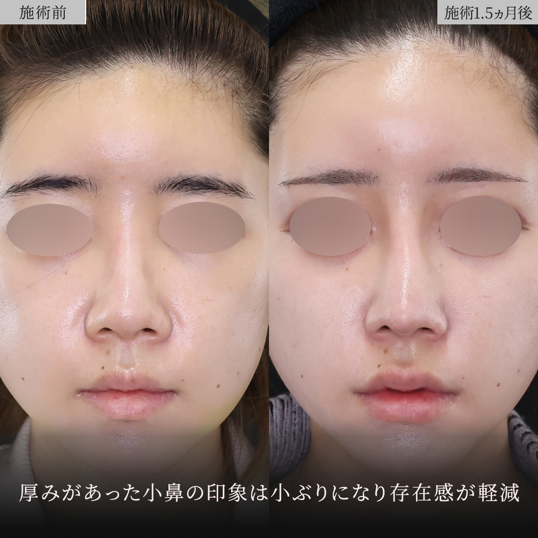 鼻中隔延長術/鼻尖形成・鼻尖縮小/鼻先軟骨移植の症例写真 施術前後 