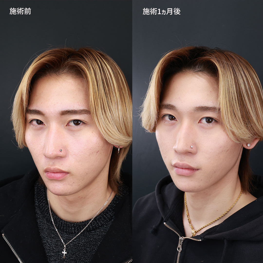 【男性美容整形】不機嫌な表情を明るく改善する、口角リフト