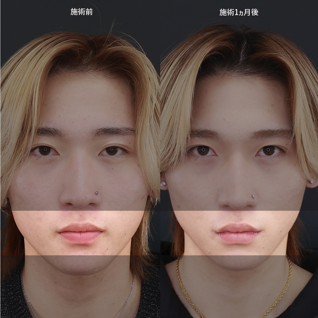 口角挙上・リフト（マイクロ切開法・内側法/口内法）の症例写真 施術前後 