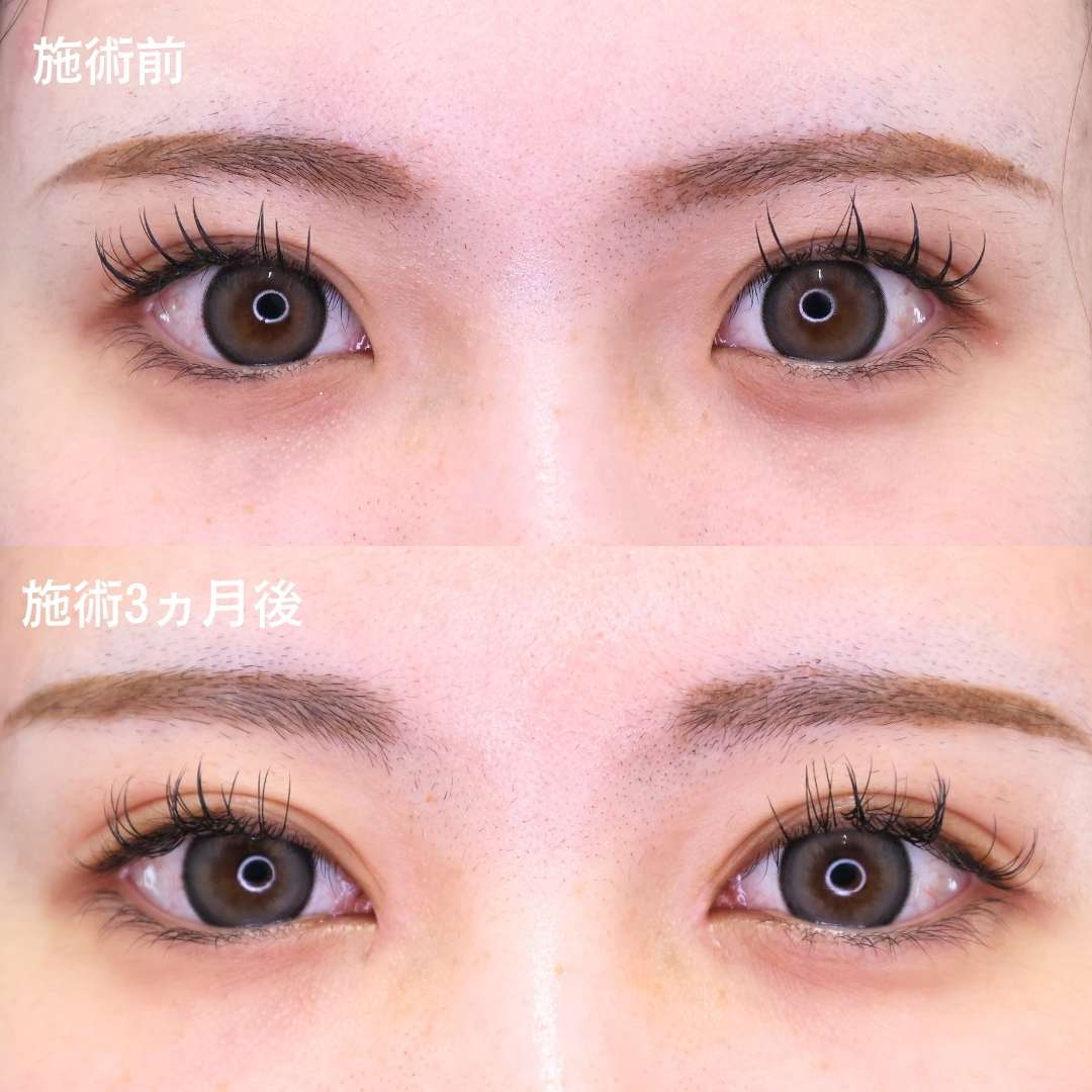 憧れのアーモンドeyeに《目頭切開》