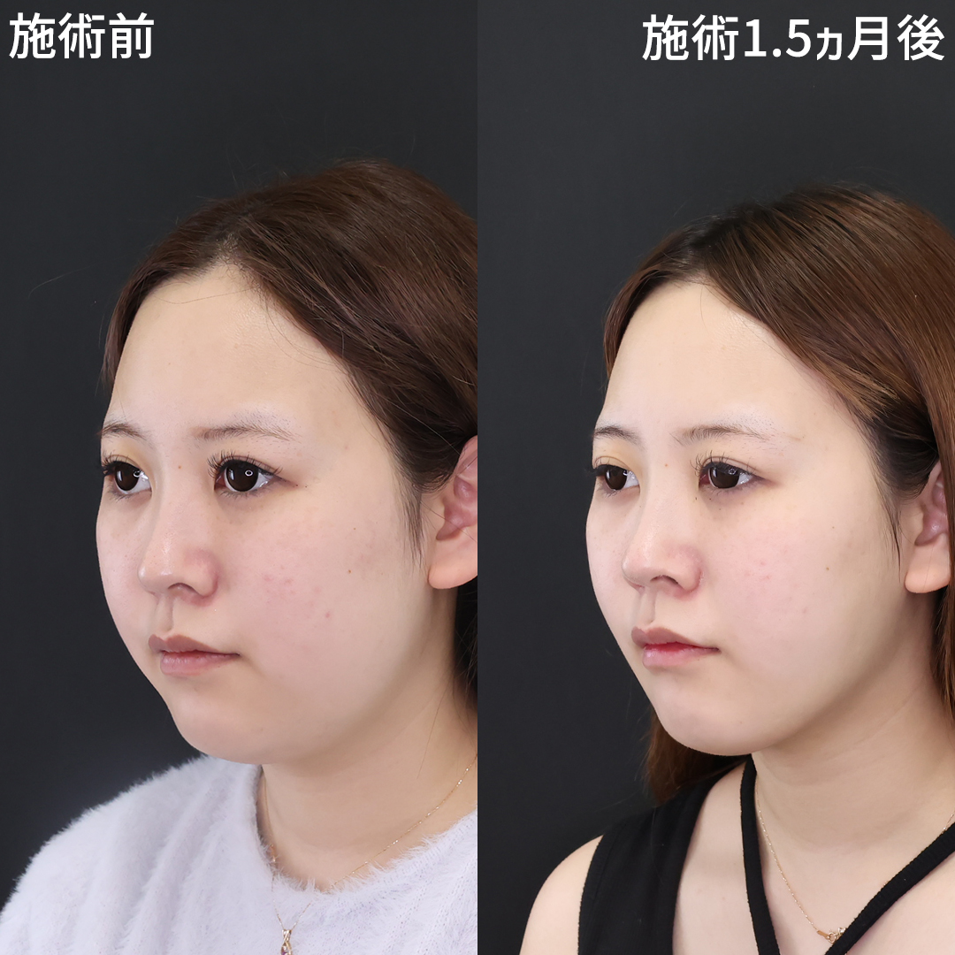もたつき、無かったことに。フェイスライン爆誕!