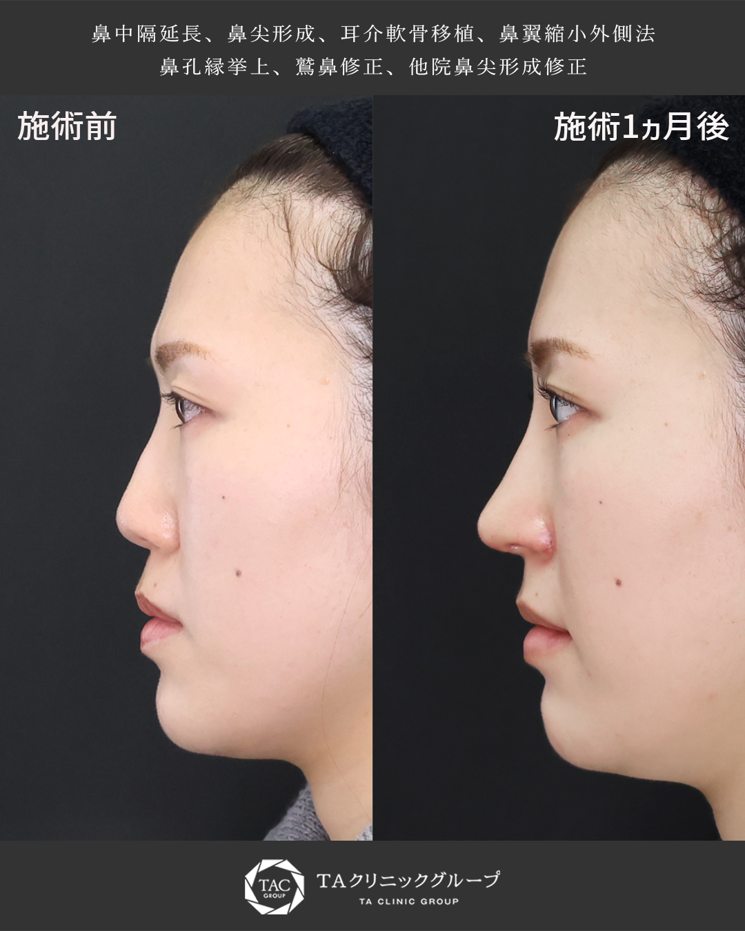 『忘れ鼻の作り方』低い鼻卒業！