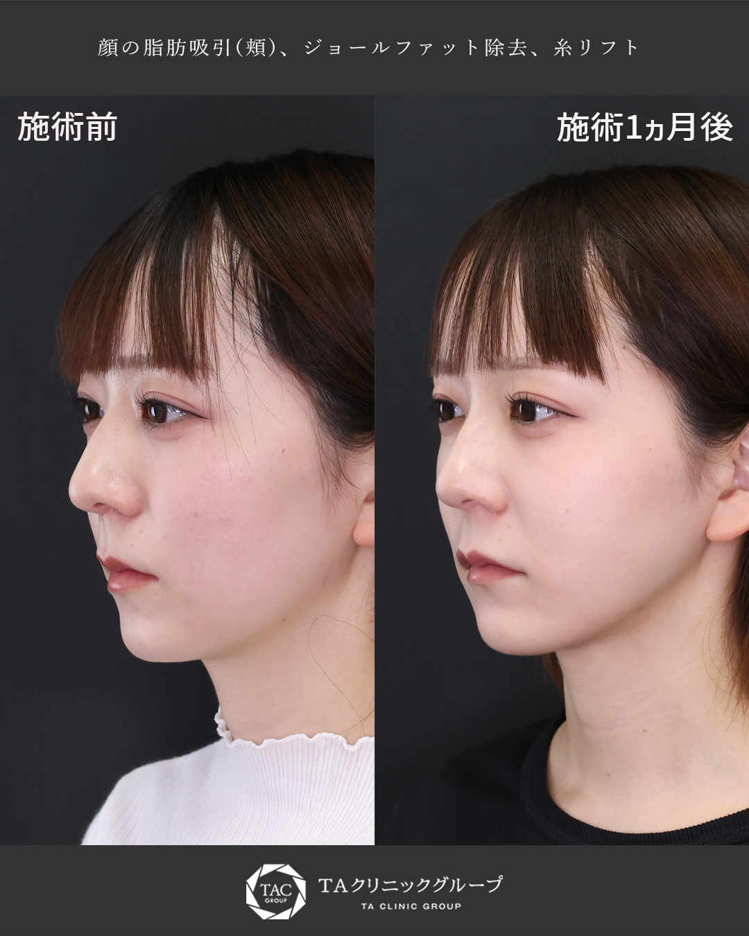 『フェイスライン爆誕』シェーディング要らずの小顔整形