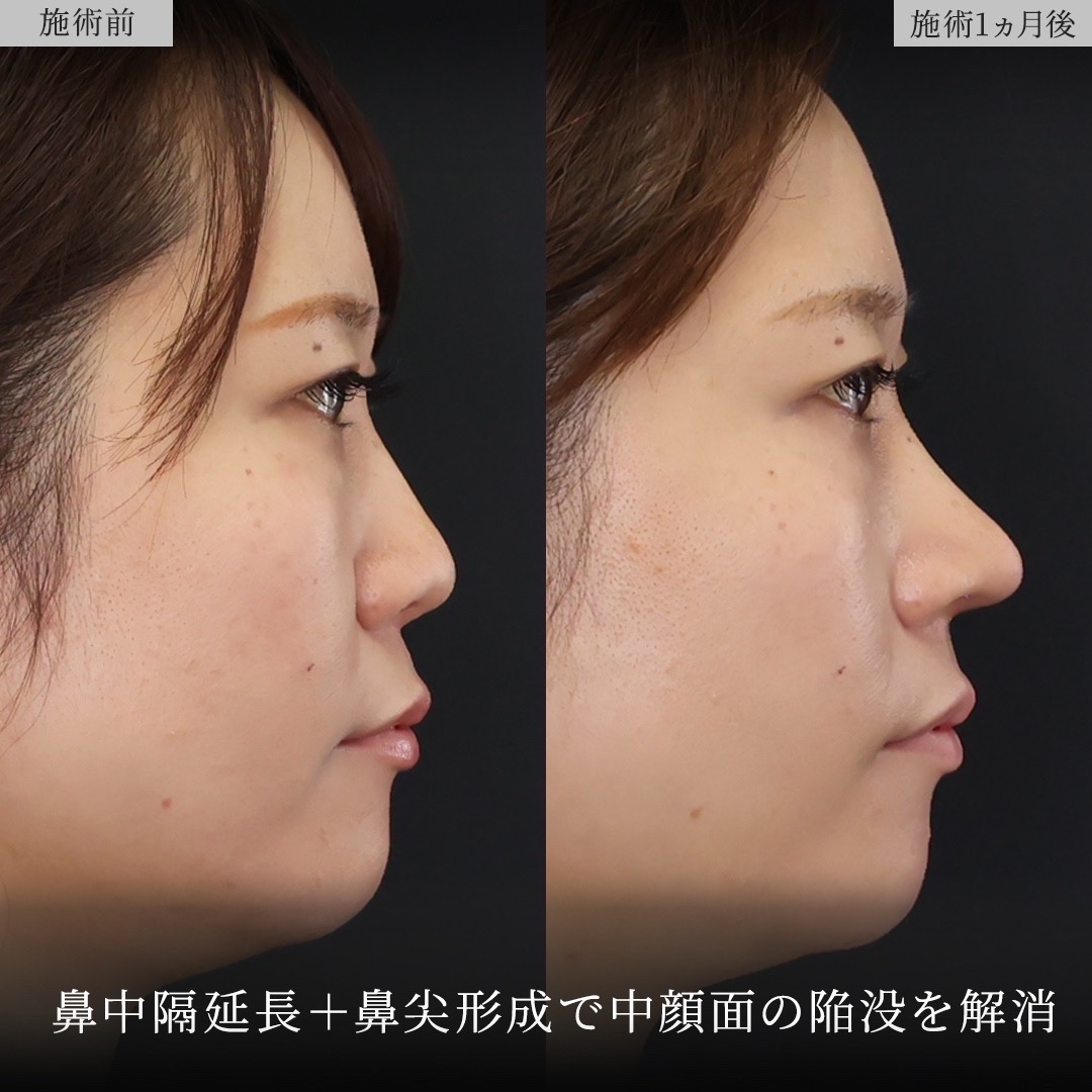 鼻中隔延長術/鼻尖形成・鼻尖縮小/鼻先軟骨移植の症例写真 施術前後 