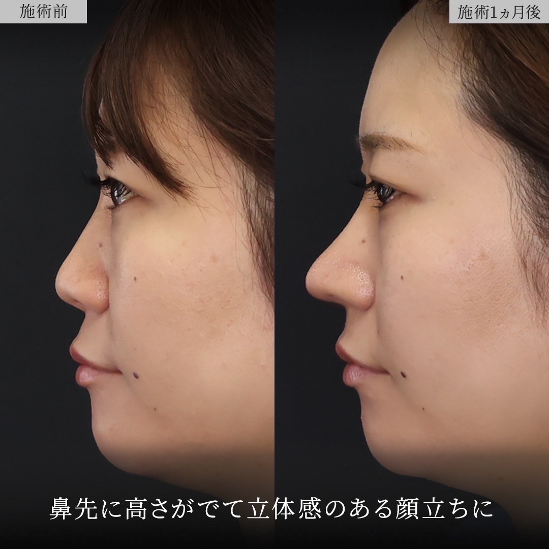 鼻中隔延長術/鼻尖形成・鼻尖縮小/鼻先軟骨移植の症例写真 施術前後 