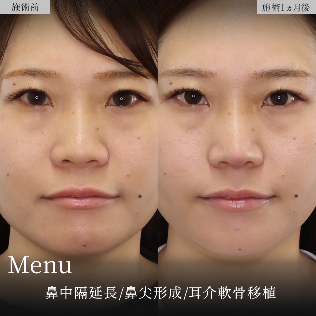 鼻中隔延長術/鼻尖形成・鼻尖縮小/鼻先軟骨移植の症例写真 施術前後 
