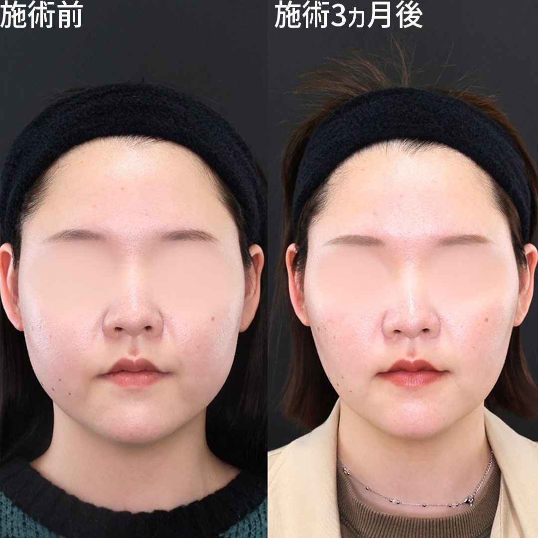 脂肪除去で下膨れ顔を改善！オーダーメイド小顔術