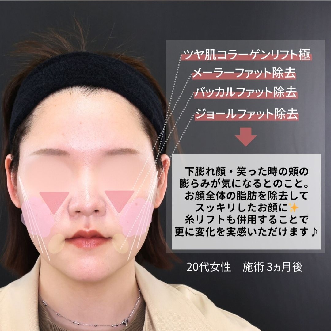 TAC式 ツヤ肌コラーゲンリフト®/バッカルファット除去/ジョールファット除去の症例写真 施術前後 