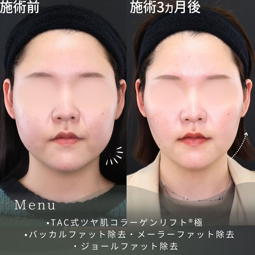 TAC式 ツヤ肌コラーゲンリフト®/バッカルファット除去/ジョールファット除去の症例写真 施術前後 
