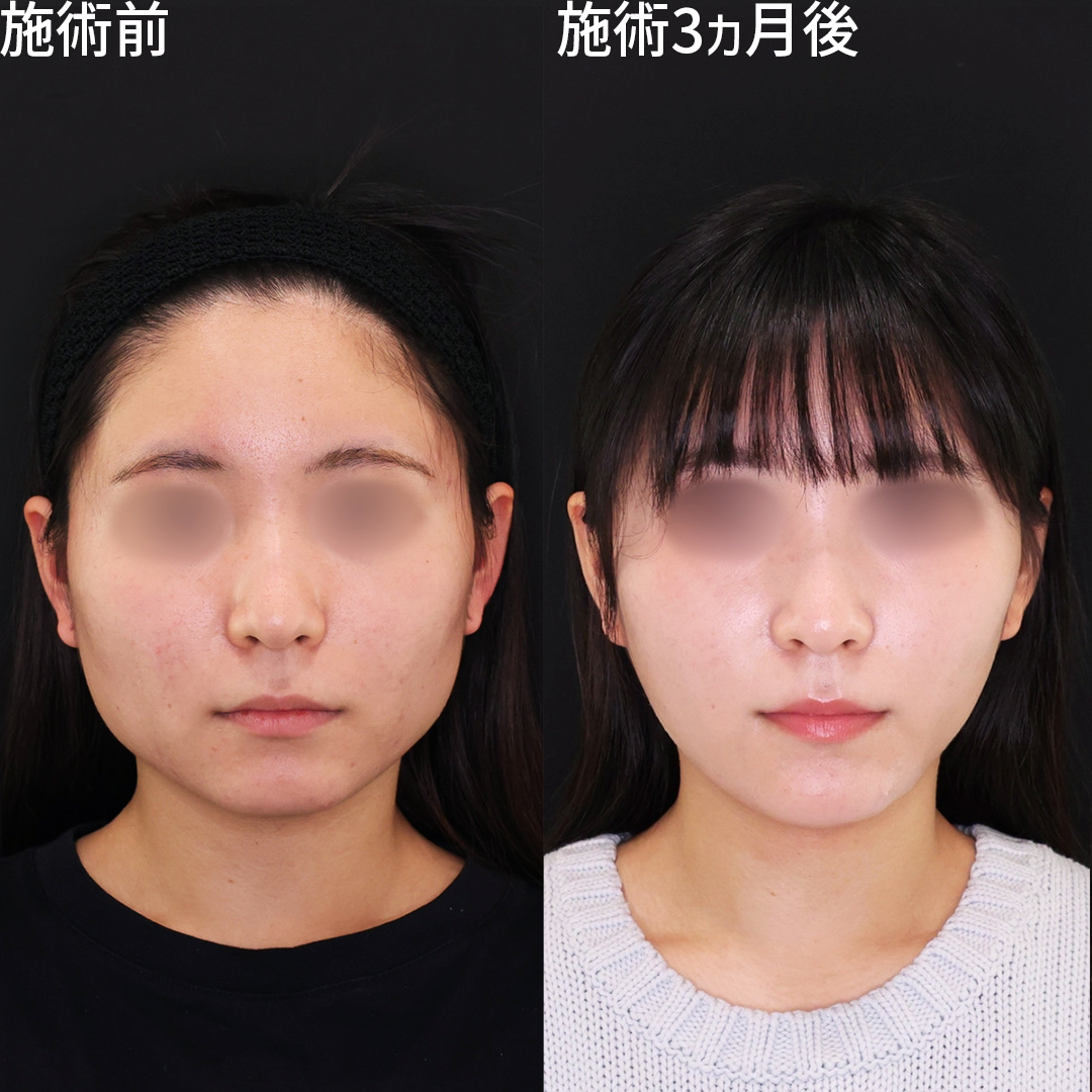 糸リフトと脂肪吸引で角ばった輪郭を卵型に！《韓国流小顔脂肪吸引》