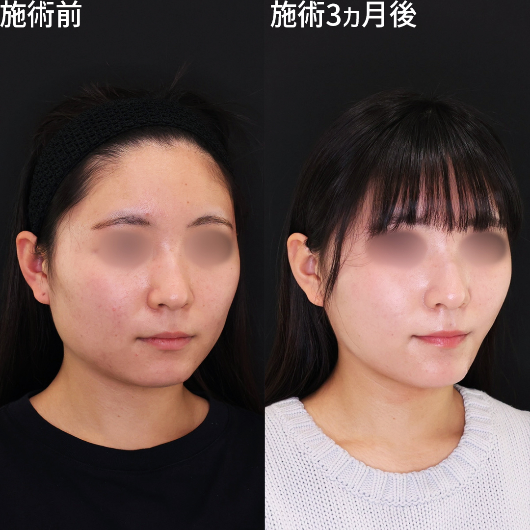 顔の脂肪吸引/TAC式 ツヤ肌コラーゲンリフト®/エラボトックス注射の症例写真 施術前後 