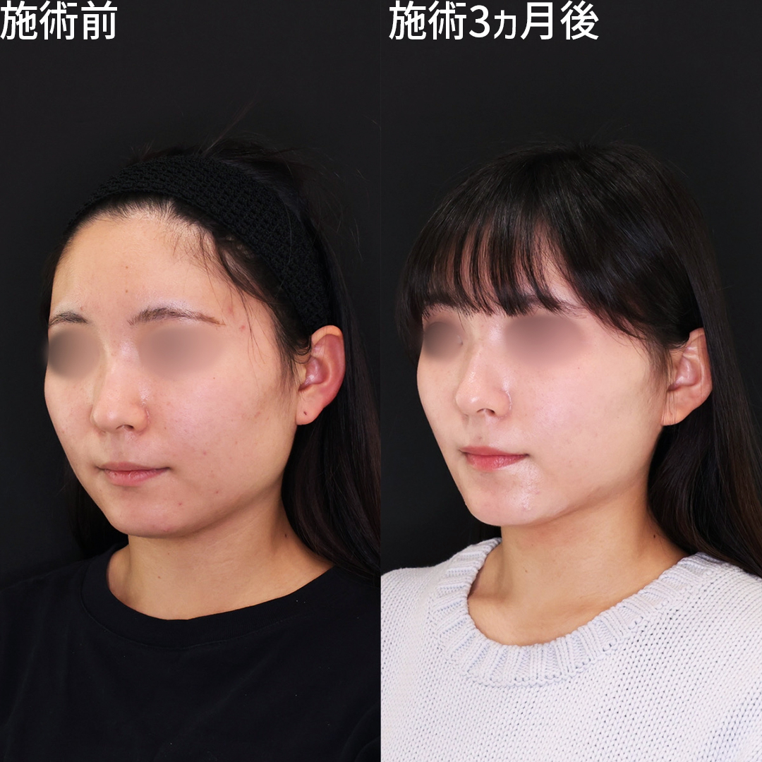 顔の脂肪吸引/TAC式 ツヤ肌コラーゲンリフト®/エラボトックス注射の症例写真 施術前後 