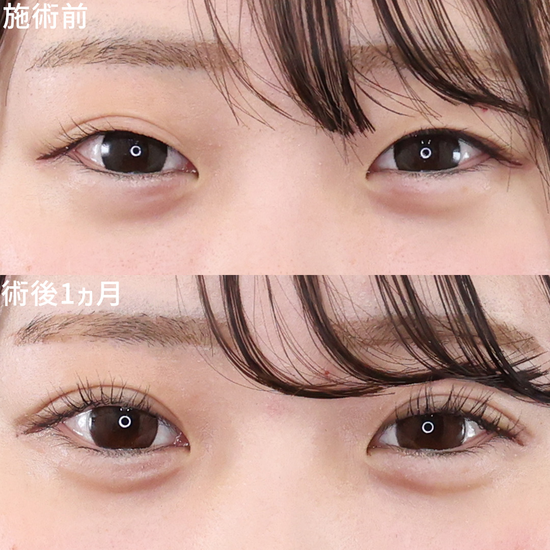 【埋没4点留め】不安定な二重ラインを整えて、理想の目元に