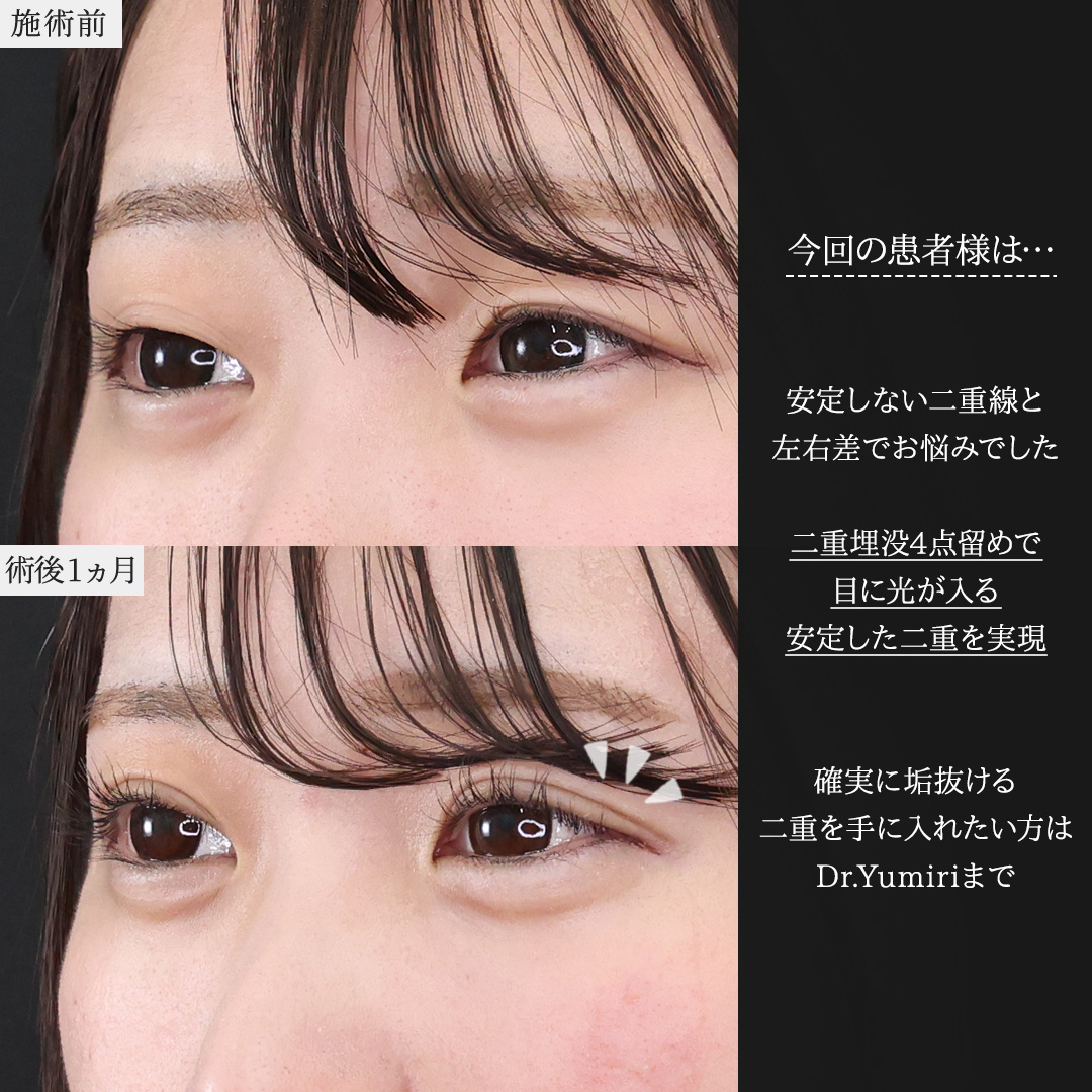 二重埋没法の症例写真 施術前後 