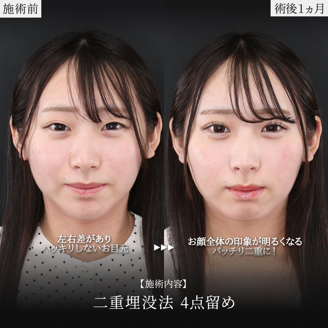 二重埋没法の症例写真 施術前後 