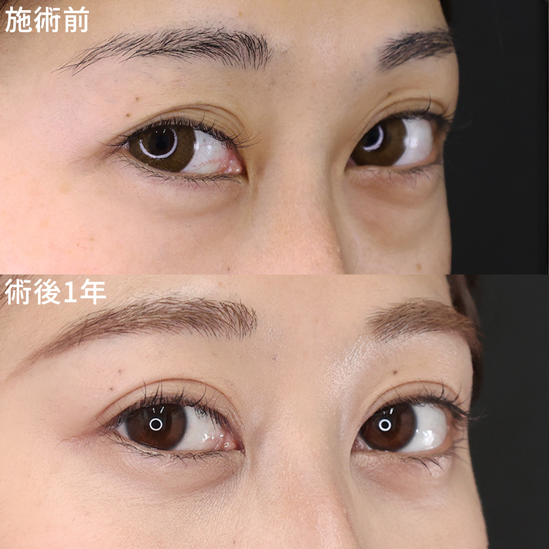 【二重埋没】で左右差を解消！安定した二重でより輝くお目元に