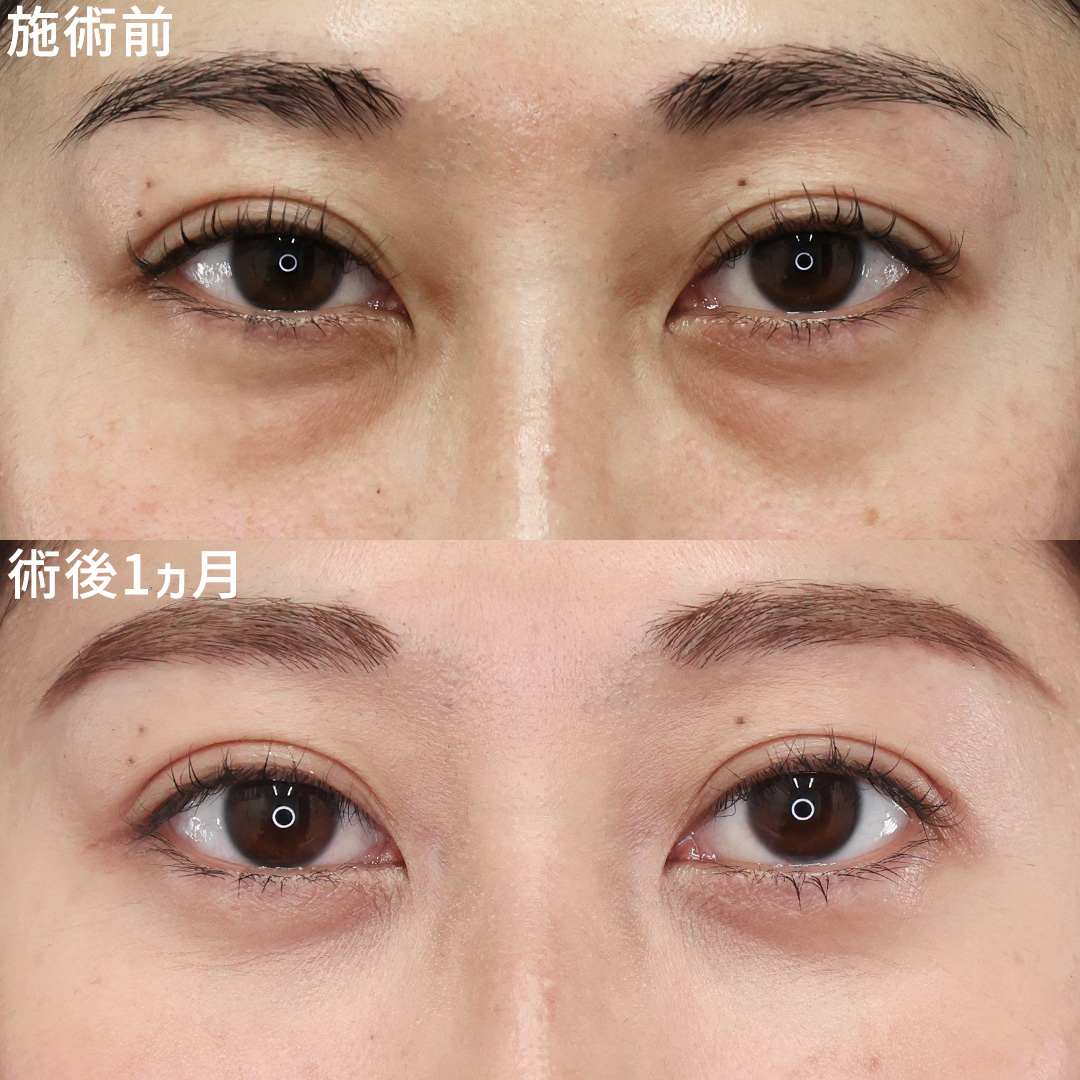 下眼瞼脱脂術（目の下のたるみ取り・目の下の脂肪ふくらみ取り）の症例写真 施術前後 