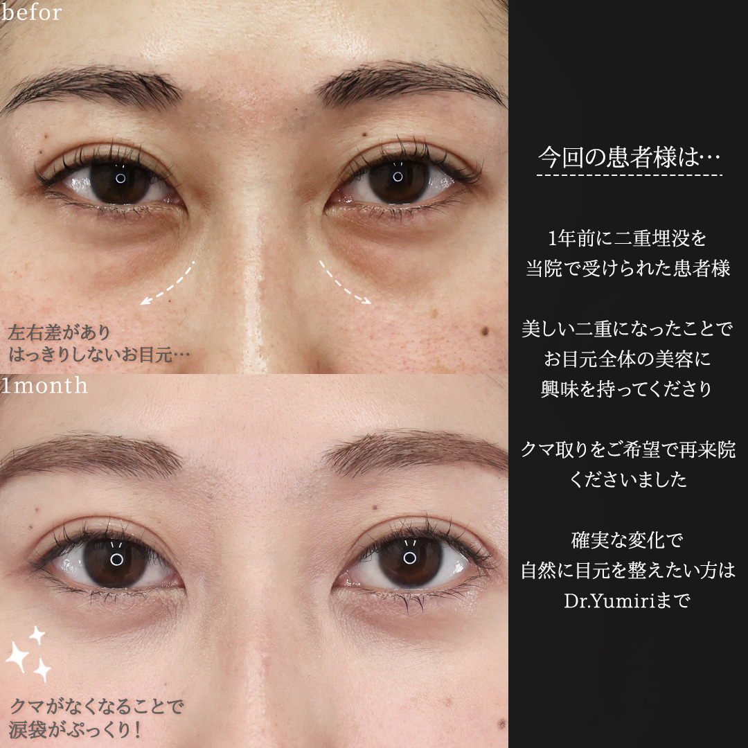 下眼瞼脱脂術（目の下のたるみ取り・目の下の脂肪ふくらみ取り）の症例写真 施術前後 