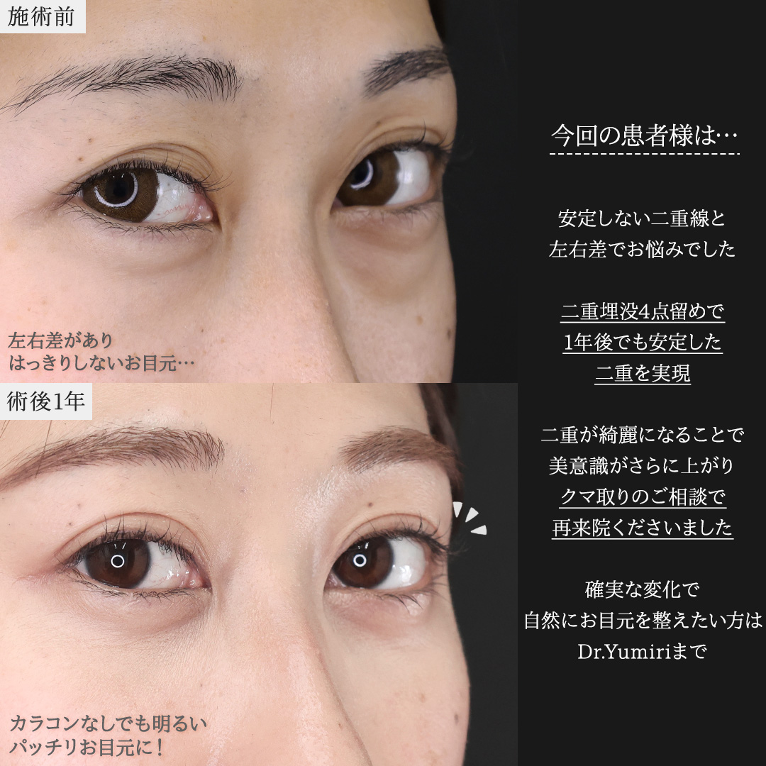 二重埋没法/下眼瞼脱脂術（目の下のたるみ取り・目の下の脂肪ふくらみ取り）の症例写真 施術前後 