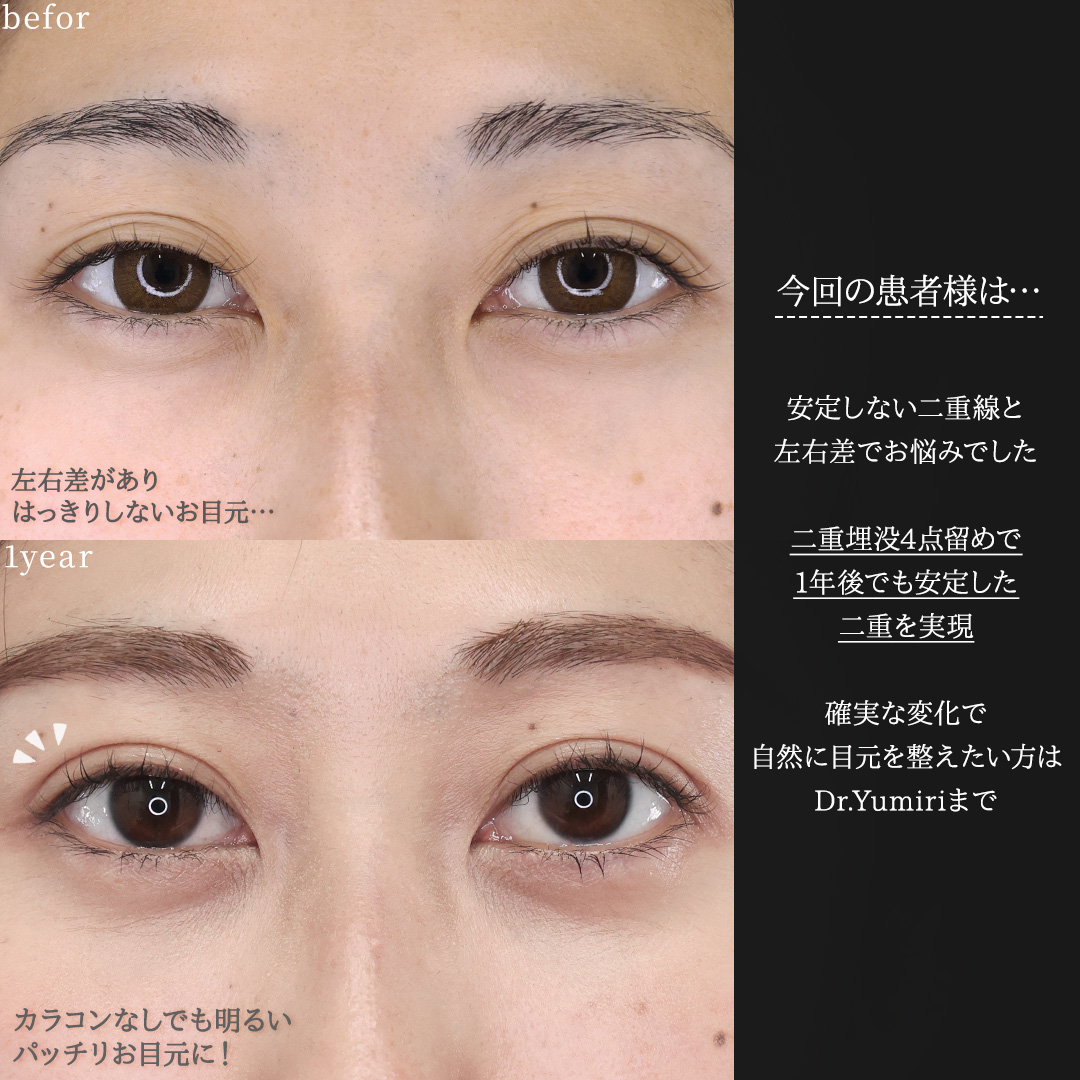 二重埋没法の症例写真 施術前後 