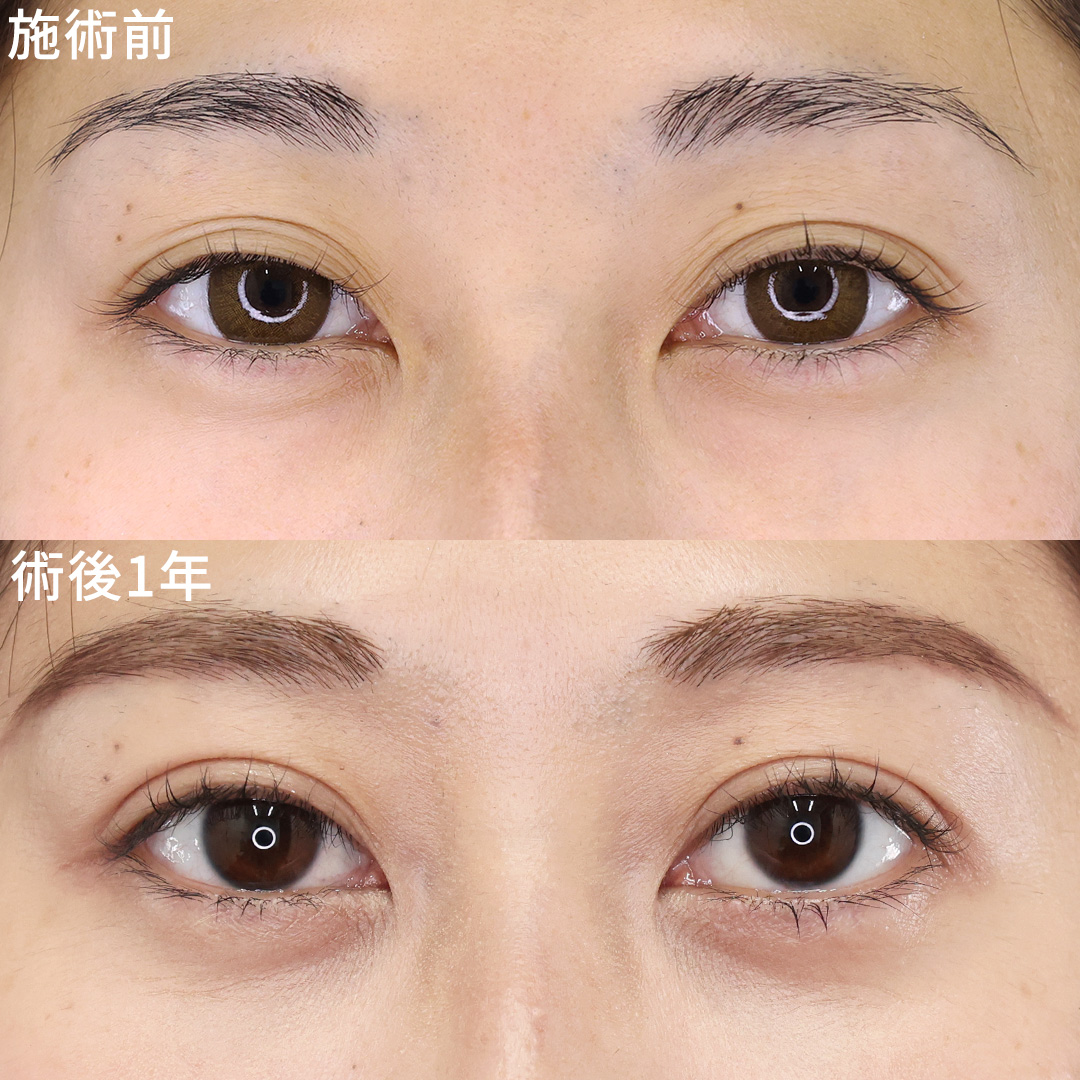 左右差とクマを解消！【埋没×クマ取り】でより輝くお目元に