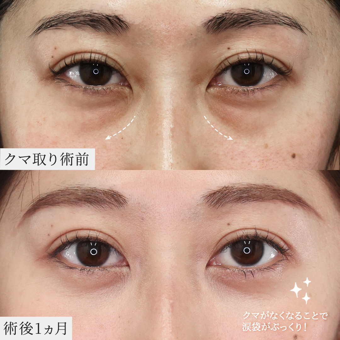 二重埋没法/下眼瞼脱脂術（目の下のたるみ取り・目の下の脂肪ふくらみ取り）の症例写真 施術前後 