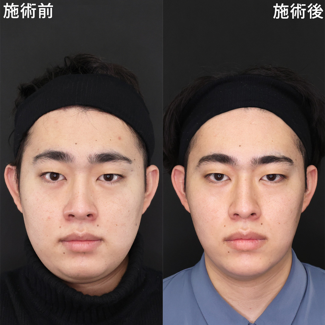 二重アゴ解消！定期的な糸リフトで小顔キープ◎