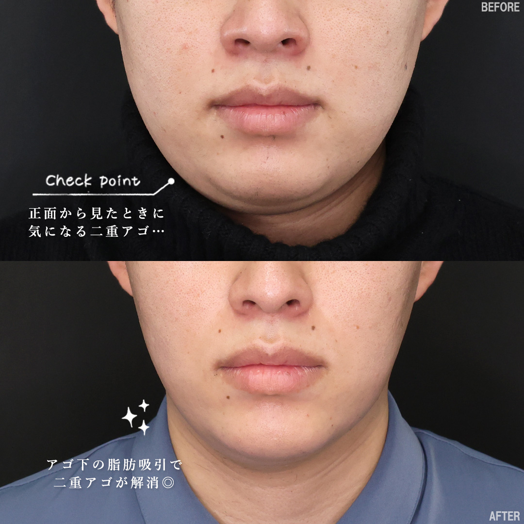 TAC式 ツヤ肌コラーゲンリフト®/顔の脂肪吸引/Lラインファット除去（エラ下脂肪除去）の症例写真 施術前後 