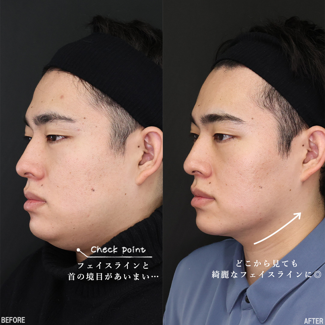 TAC式 ツヤ肌コラーゲンリフト®/顔の脂肪吸引/Lラインファット除去（エラ下脂肪除去）の症例写真 施術前後 