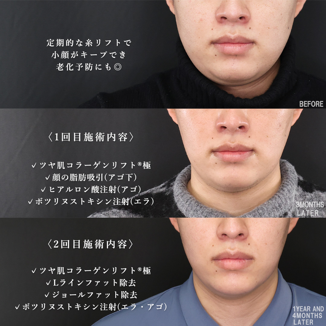 TAC式 ツヤ肌コラーゲンリフト®/顔の脂肪吸引/Lラインファット除去（エラ下脂肪除去）の症例写真 施術前後 