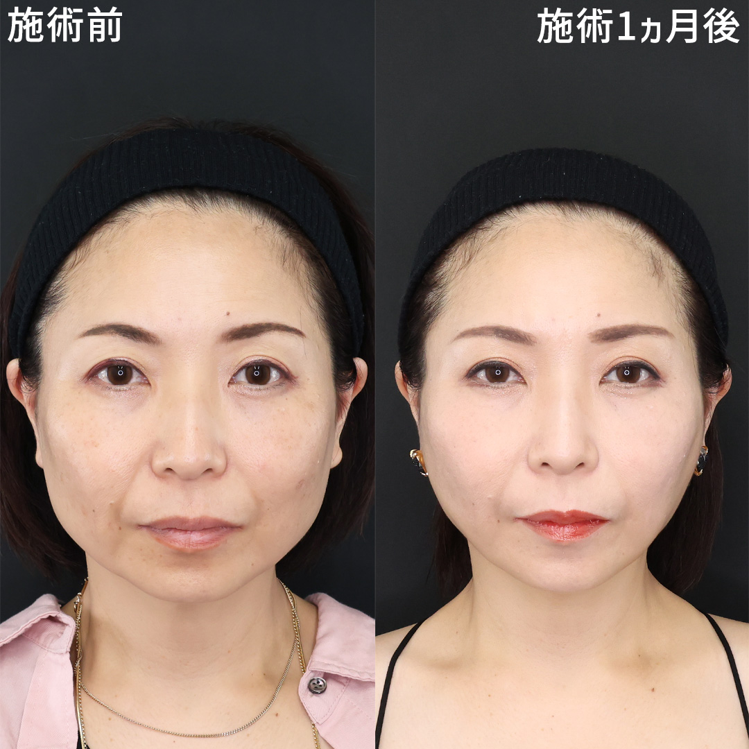 輪郭ケアで若見えフェイスへ｜40代女性のナチュラル美整形