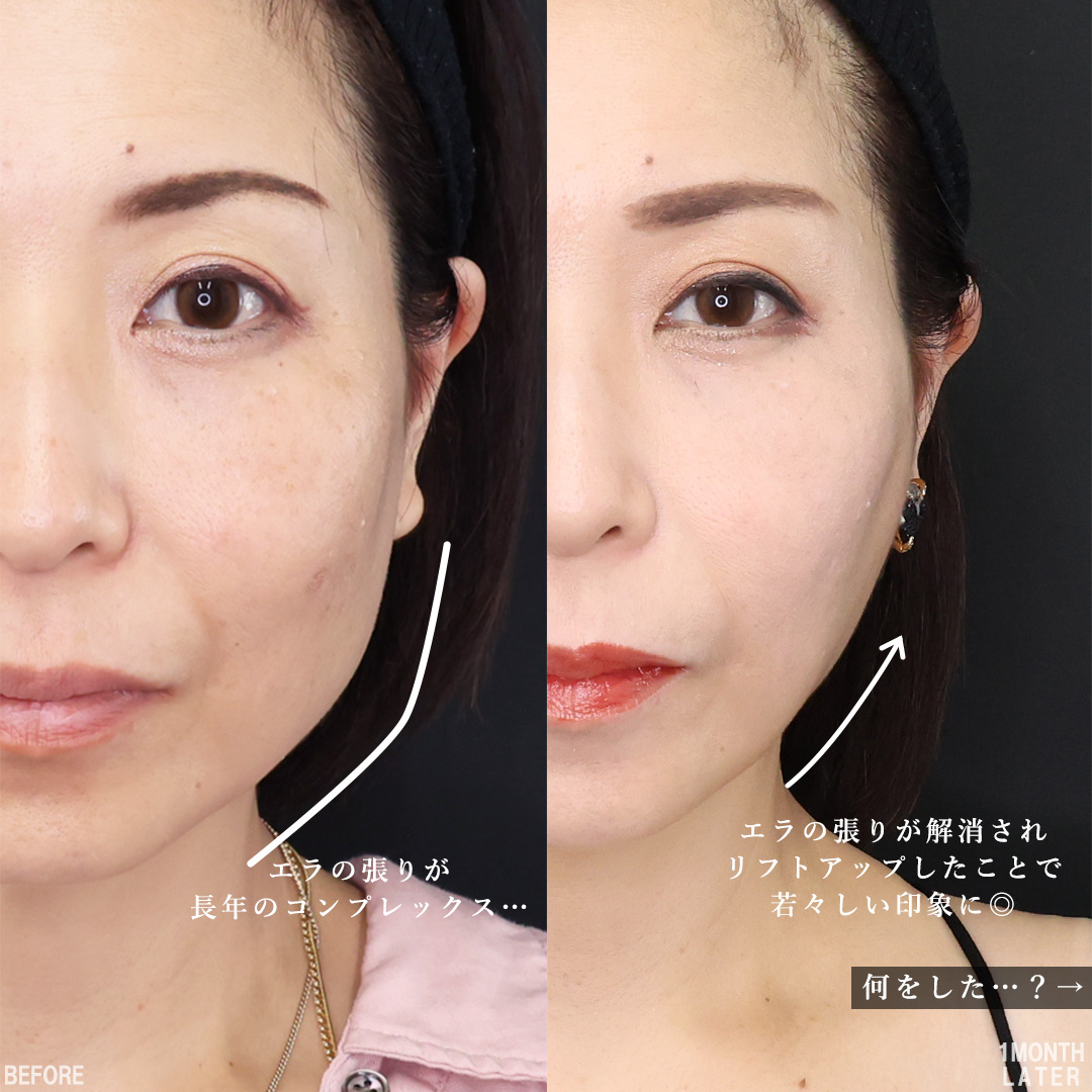TAC式 ツヤ肌コラーゲンリフト®/Lラインファット除去（エラ下脂肪除去）/エラボトックス注射の症例写真 施術前後 