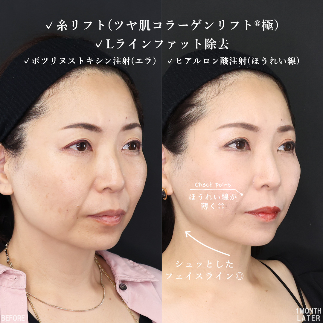 TAC式 ツヤ肌コラーゲンリフト®/Lラインファット除去（エラ下脂肪除去）/エラボトックス注射の症例写真 施術前後 