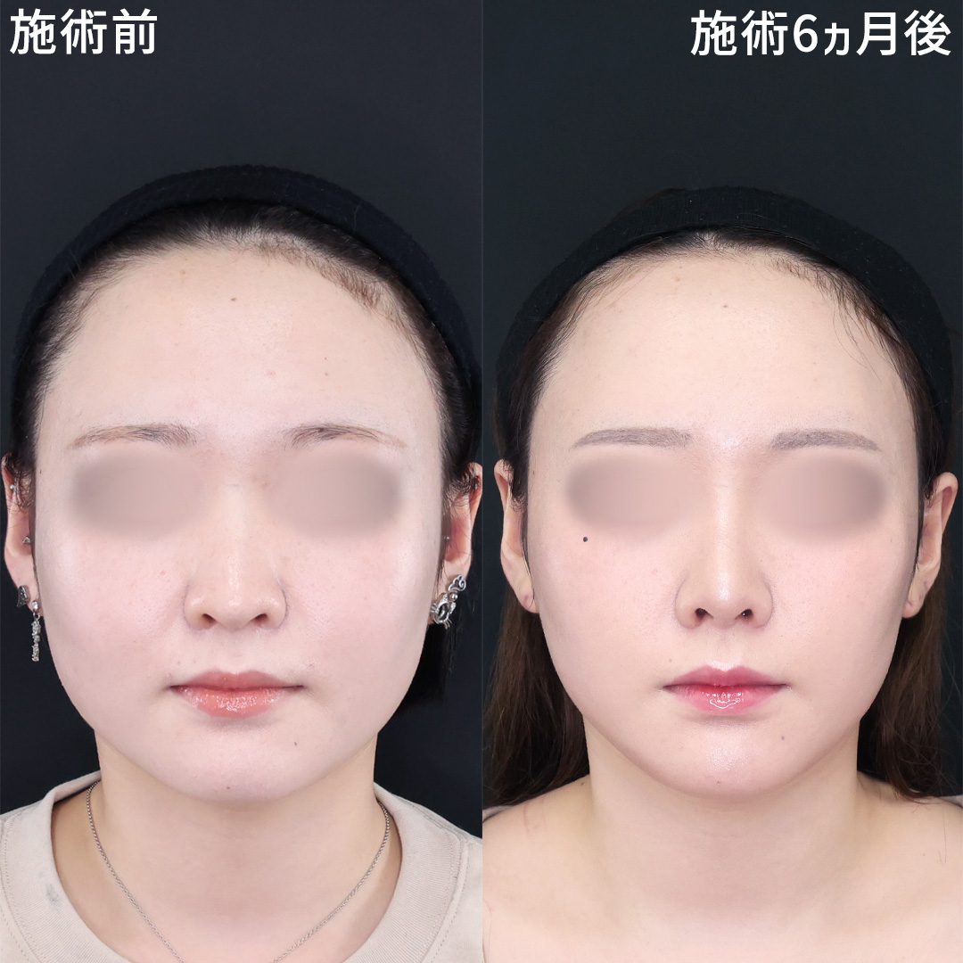 隆鼻術(プロテーゼ・自家組織)/鼻先軟骨移植/鼻尖形成・鼻尖縮小の症例写真 施術前後