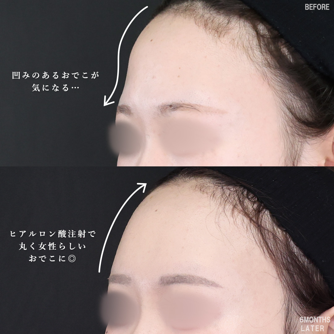 隆鼻術(プロテーゼ・自家組織)/鼻先軟骨移植/鼻尖形成・鼻尖縮小の症例写真 施術前後
