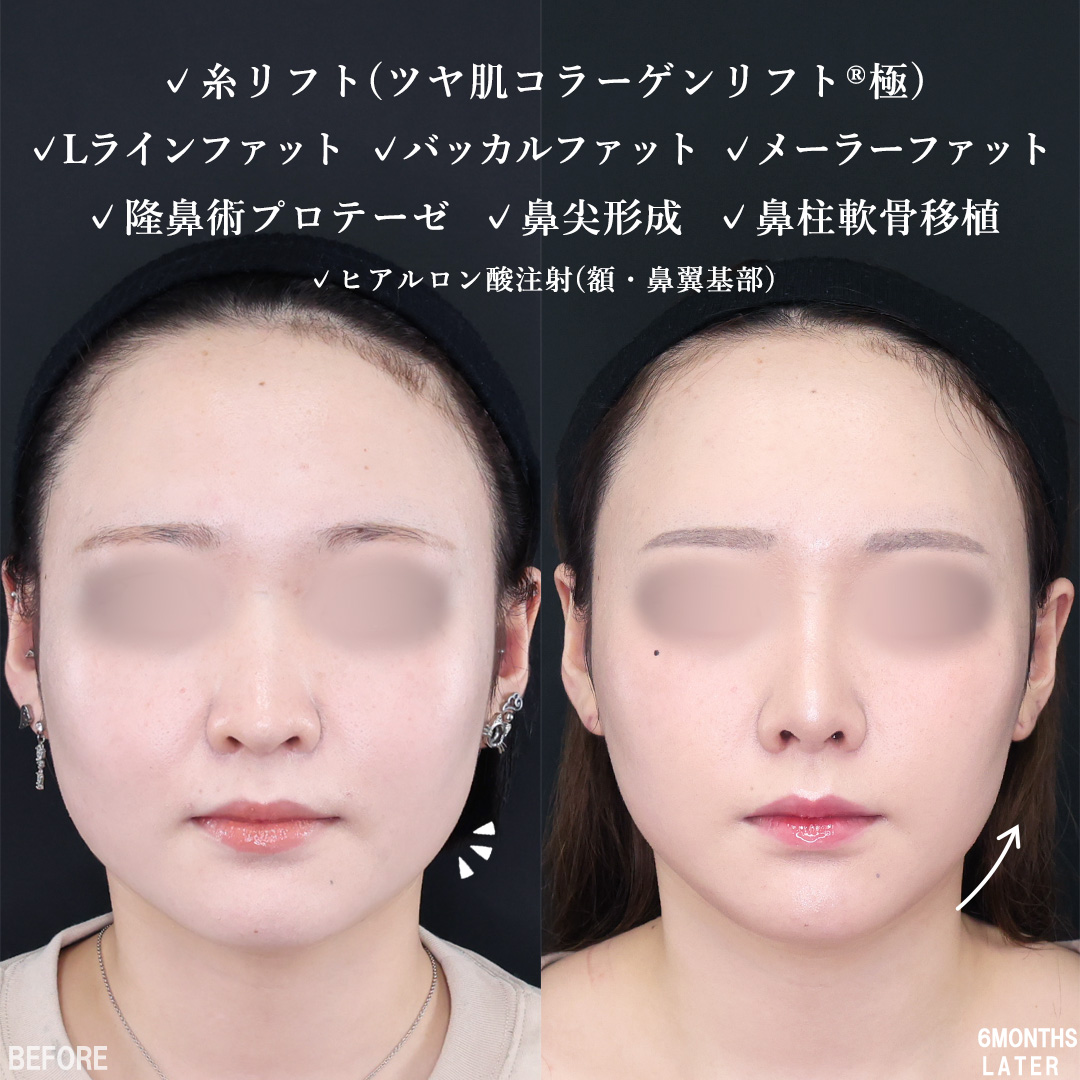 隆鼻術(プロテーゼ・自家組織)/鼻先軟骨移植/鼻尖形成・鼻尖縮小の症例写真 施術前後