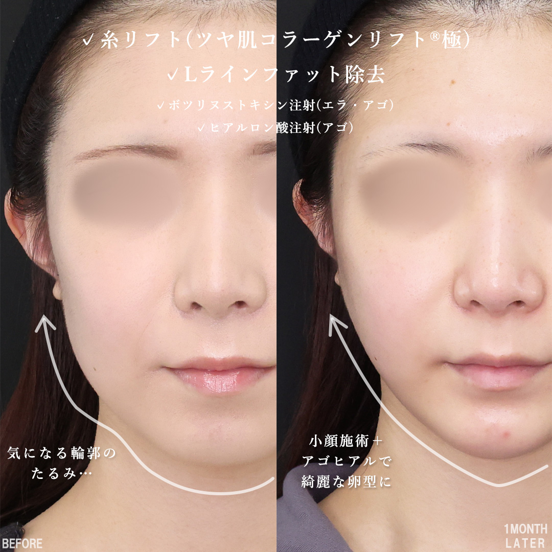 TAC式 ツヤ肌コラーゲンリフト®/Lラインファット除去（エラ下脂肪除去）/エラボトックス注射の症例写真 施術前後 