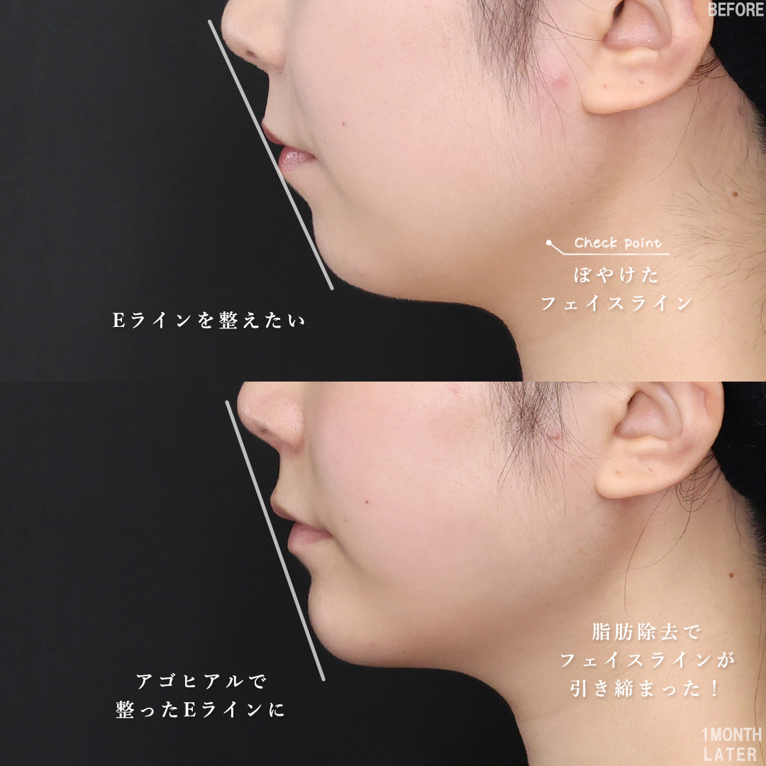 TAC式 ツヤ肌コラーゲンリフト®/Lラインファット除去（エラ下脂肪除去）/エラボトックス注射の症例写真 施術前後 