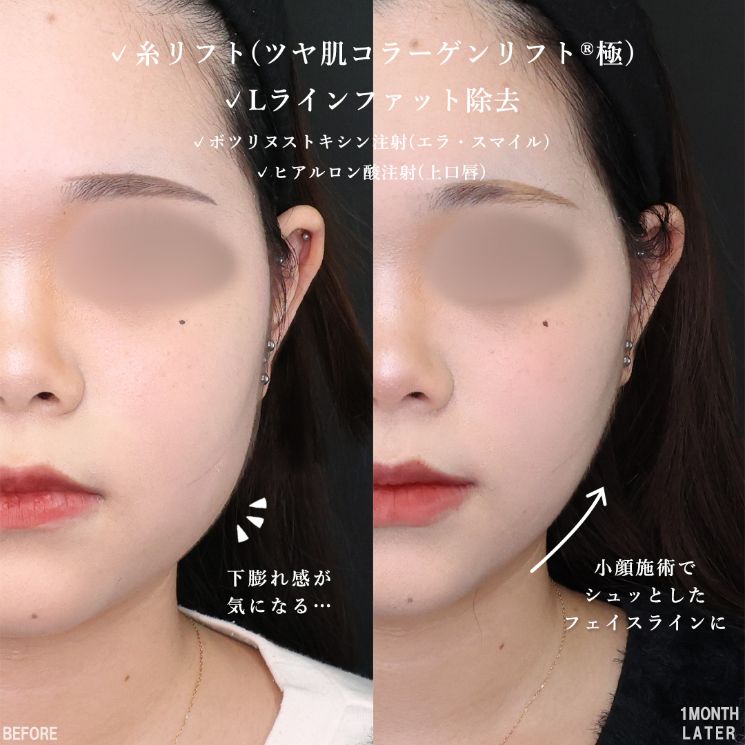 TAC式 ツヤ肌コラーゲンリフト®/Lラインファット除去（エラ下脂肪除去）/エラボトックス注射の症例写真 施術前後 