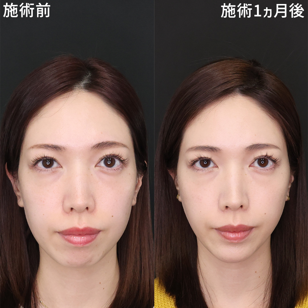 “口ゴボ”感がすっきり。横顔美人へアップデート◎