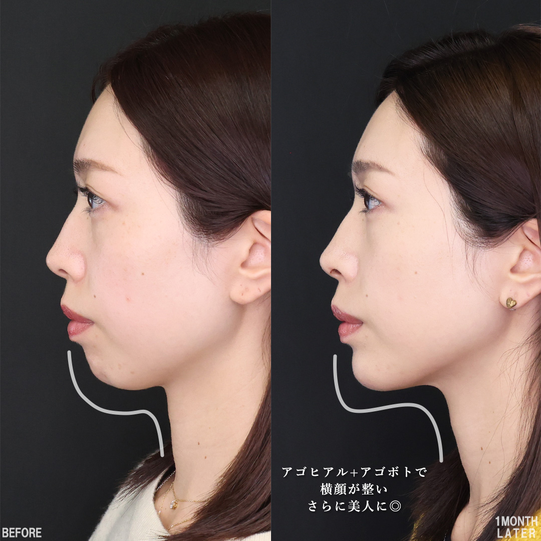 TAC式 ツヤ肌コラーゲンリフト®/顎のヒアルロン酸注射/エラボトックス注射の症例写真 施術前後