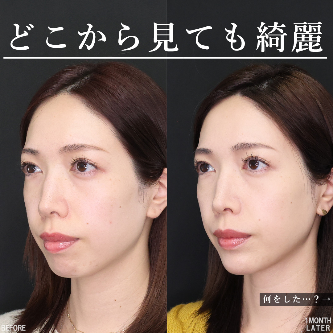 TAC式 ツヤ肌コラーゲンリフト®/顎のヒアルロン酸注射/エラボトックス注射の症例写真 施術前後